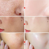 2PCS Acne Treatment Skin Care